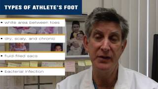 How can I tell if I have Athlete's Foot? What Causes Athlete's Foot?