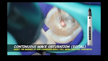 Continuous wave obturation warm vertical compaction 4 canals endodontic fast fill  pack eighteeth