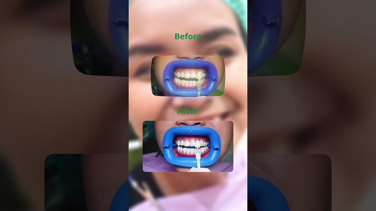 Premium Whitening by Philips Zoom!
