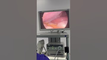 Trực tiếp cắt túi mật #Soithan #tansoithan  #bacsitung #pcnl #aroretic #akicare #soituimat