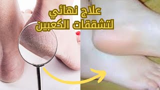 كريم منزلي لعلاج تقرحات و تشققات الكعبين