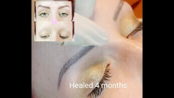 Alopecia Microblading Eyebrows Before and After Healed