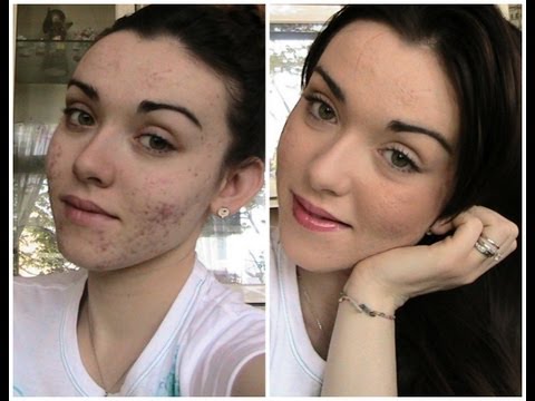 Come guarire tracce rosse di posti sulla faccia