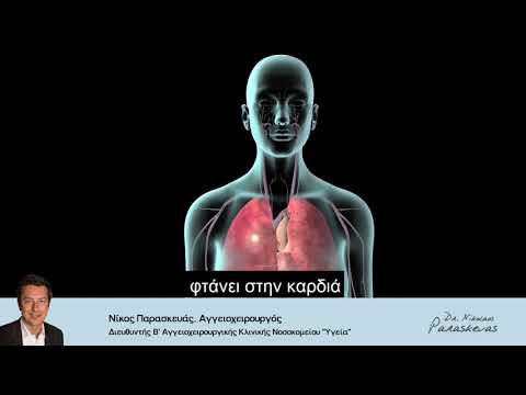 Βίντεο: 3 τρόποι για την πρόληψη της πνευμονικής εμβολής