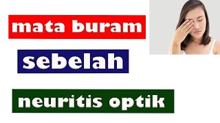 MATA BURAM SEBELAH || Neuritis Optik