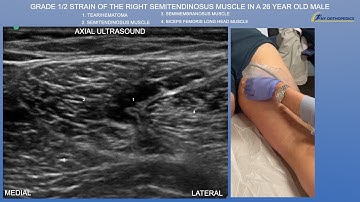 Ultrasound of Grade 1/2 Hamstring Strain in a 26 Year Old Male by probeultrasound