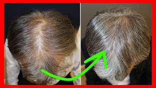 Tienes más de 50 años y quieres recuperar tu pelo sin injerto
