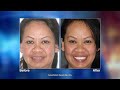 No More Dentures with Dental Implants | Art Mirelez, DDS – Fresno, CA Dentist