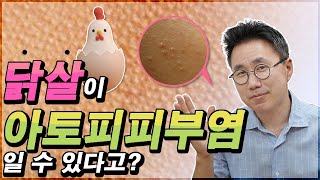 모공각화증이 아토피피부염의 증상일 수 있다는 사실을 아시나요? 🐣닭살인데 아토피?