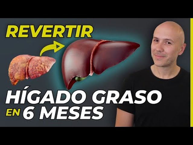 ELIMINA LA GRASA DEL HÍGADO EN MENOS DE 6 MESES | EL TRATAMIENTO MÁS EFECTIVO CONTRA EL HÍGADO GRASO