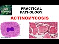 Practical Pathology: ACTINOMYCOSIS