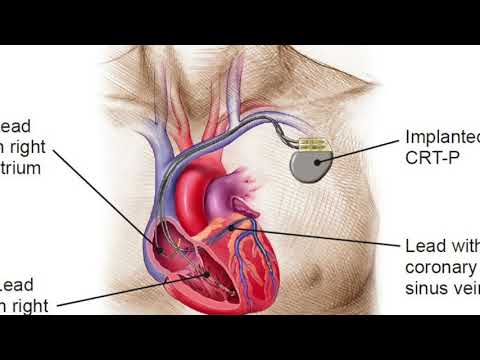 PACEMAKERS: PACE CARDIOLOGY
