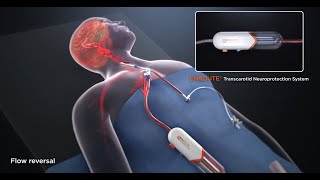 TCAR Procedure Patient Animation