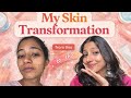 Glowing Skin In 30 Days | My Skincare Routine | Skin Transformation | Healthy Skin