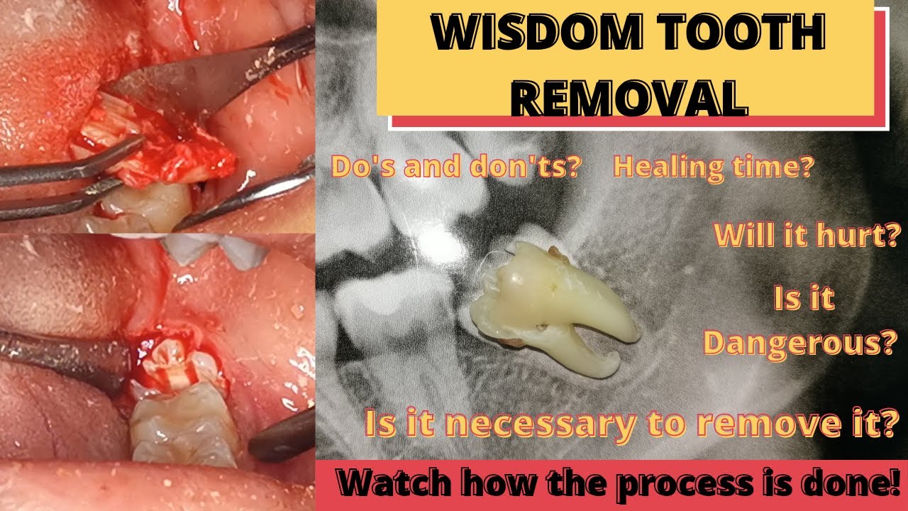 Wisdom Tooth Removal Processsurgery And All Things You Need To Know