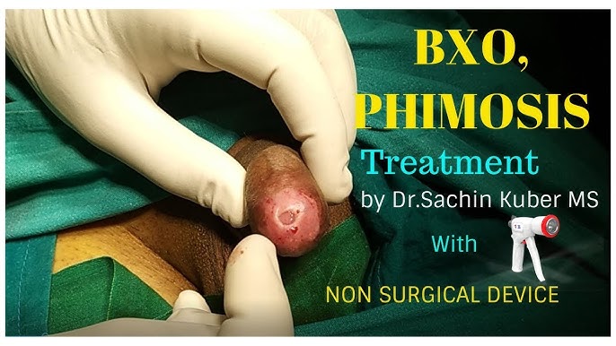 How to cure BXO,Phimosis,Balanitis Treatment with ZSR Circumcision by  Dr.Kuber Call +919370275336 