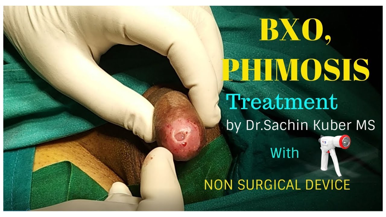 Bxo Phimosis Balanitis Treatment With Non Surgical Circumcision By Dr Kuber Call 919370275336 Youtube