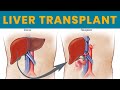 Dr neerav goyal best liver transplant surgeon in india talks about various liver diseases