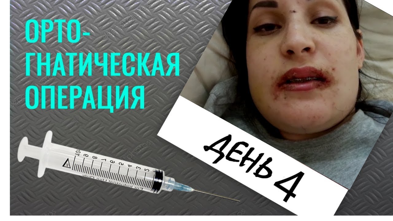 У меня всё болит! Челюстно лицевая хирургия на 4 день - YouTube