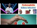 Pyelonephritis Part 03 Kutaa 3ffaa Barnoota Fayyaa Dhibee Kalee Wajjiin Walqabatu Medicalstudent Pyelonephritis Part 03 Kutaa 3ffaa Barnoota Fayyaa Dhibee Kalee Wajjiin Walqabatu Medicalstudent