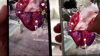 Medica Education using 3D Medical Animations #AugmentedReality #InsightHeart @animares screenshot 1