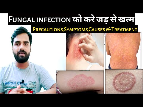 दाद को करे जड से खतम |Best Medicine For Getting therengal Infection | Getting therellJacketrmation | medicaljankari