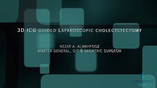 3D 4K ICG guided laparoscopic cholecystectomy  رفع المرارة  بالمنظار ٣ أبعاد  بتقنية الصبغة المنيرة