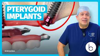 DR BRUNO SILVA: When Are Pterygoid Implants the Right Choice?