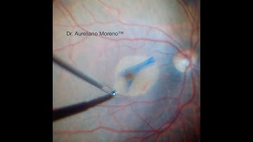 Modified Inverted ILM Flap Technique for Macular Hole After Vitrectomy for Retinal Detachment