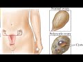 PCOD / PCOS - कारण, लक्षण और घरेलू उपचार | Home Remedies for Poly cystic Ovarian Syndrome