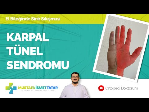 KARPAL TÜNEL SENDROMU
