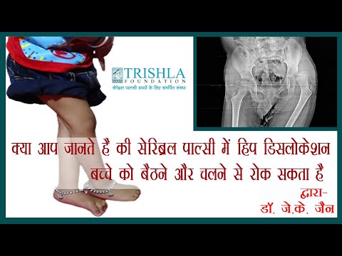 Dislocation of hip joint in cerebral palsy: causes, prevention  & treatment | Trishla Foundation