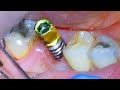  full dental implant procedure before and after  extraction surgery  crown on back tooth molar