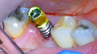 🦷 Full DENTAL IMPLANT PROCEDURE! Before and After - Extraction, Surgery, & Crown On Back Tooth Molar