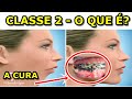O que é a Classe 2 em Ortodontia? Tem tratamento?