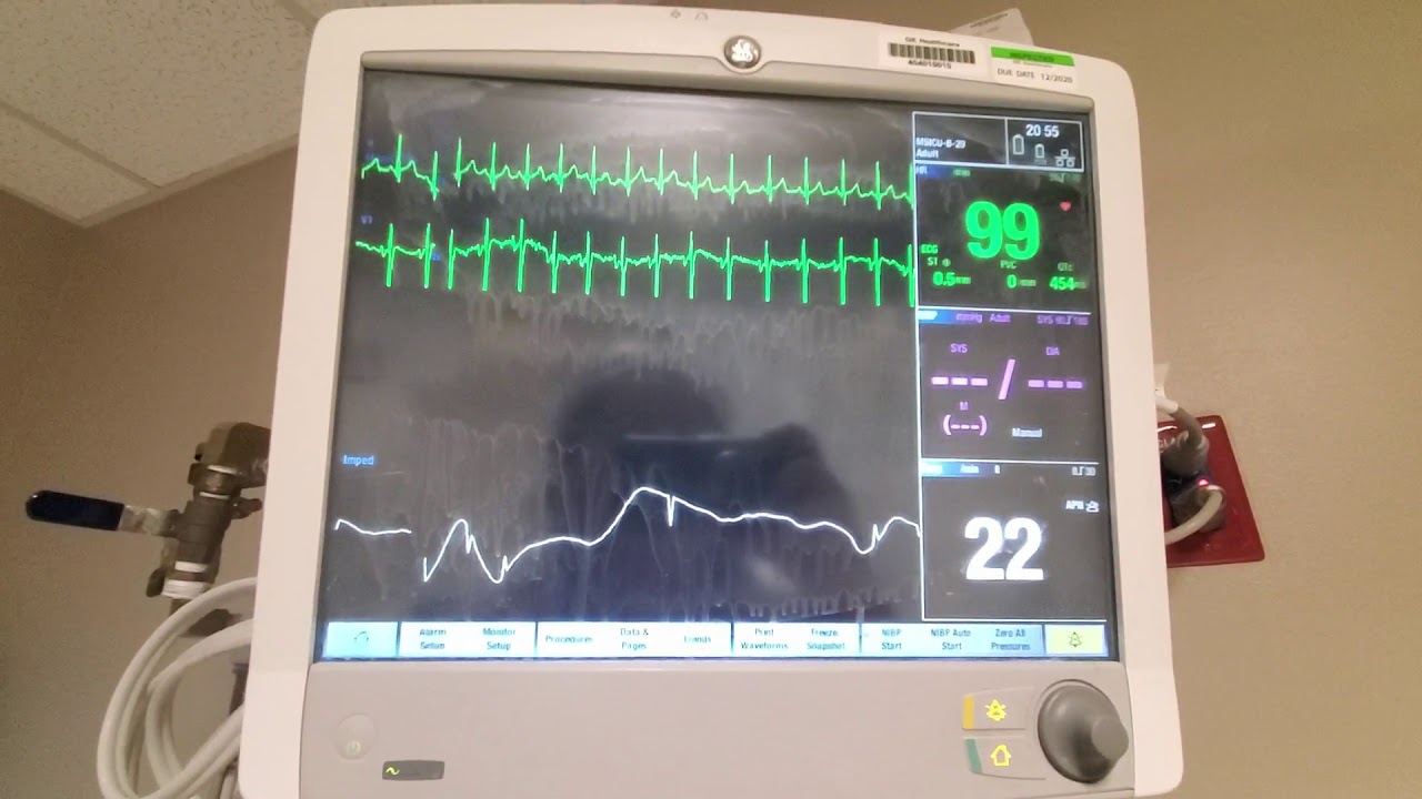 Tips for GE Bedside Monitors YouTube