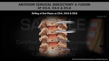 Anterior Cervical Discectomy & Fusion at C3-4, C4-5 & C5-6
