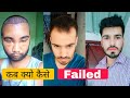 From Hair Transplant Surgery To Full Hair Transplant Result || Best Hair Transplant In India