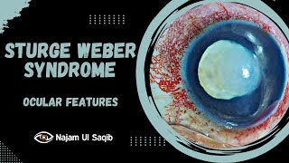 Ocular Signs Of Sturge Weber Syndrome