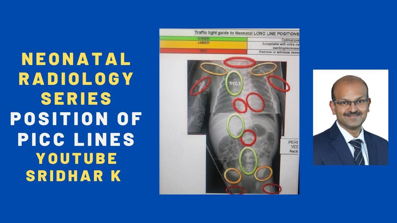 Picc Line Xray marriage-on-the-brink-time-out-and-infidelity-cheating-wife-stories