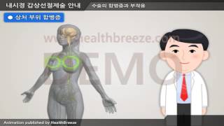 [시연용] c0079abko 내시경 갑상선절제술 안내 ENT