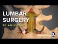 Lumbar Surgery - Laminectomy - 3D Medical Animation