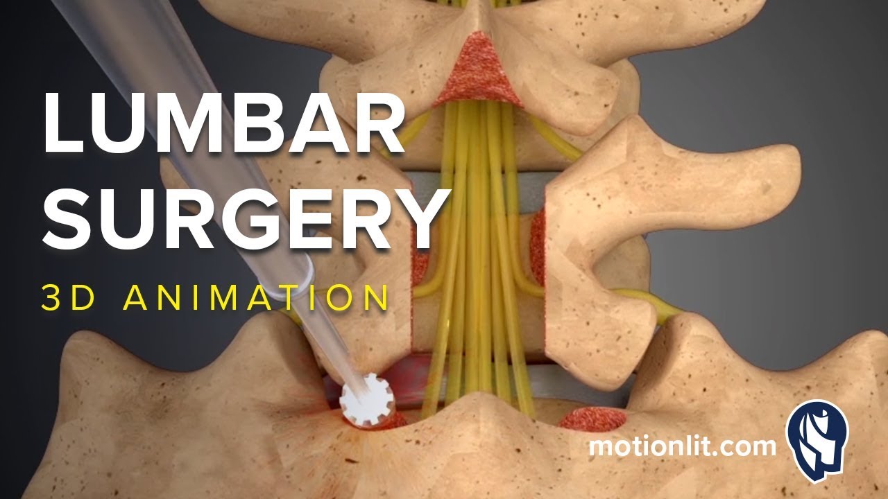 Is a laminectomy a major surgery?