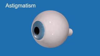 Astigmatism
