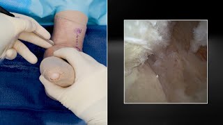 Revolutionizing Ankle Arthroscopy Using the NanoNeedle™ Scope 2.0