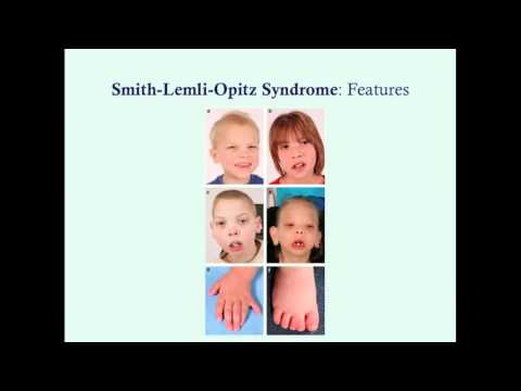 Smith-Lemli-Opitz Syndrome - CRASH! Medical Review Series