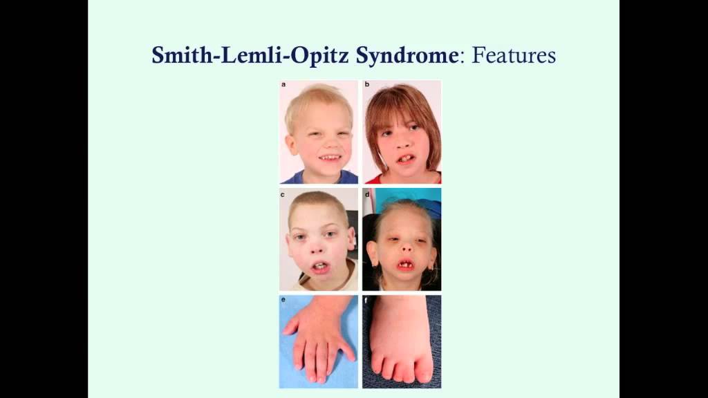Smith Lemli Opitz Syndrome CRASH Medical Review Series YouTube smith-lemli-opitz-syndrome-crash-medical-review-series-youtube