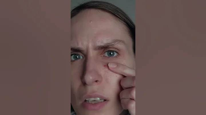 Does toothpaste really cure acne?