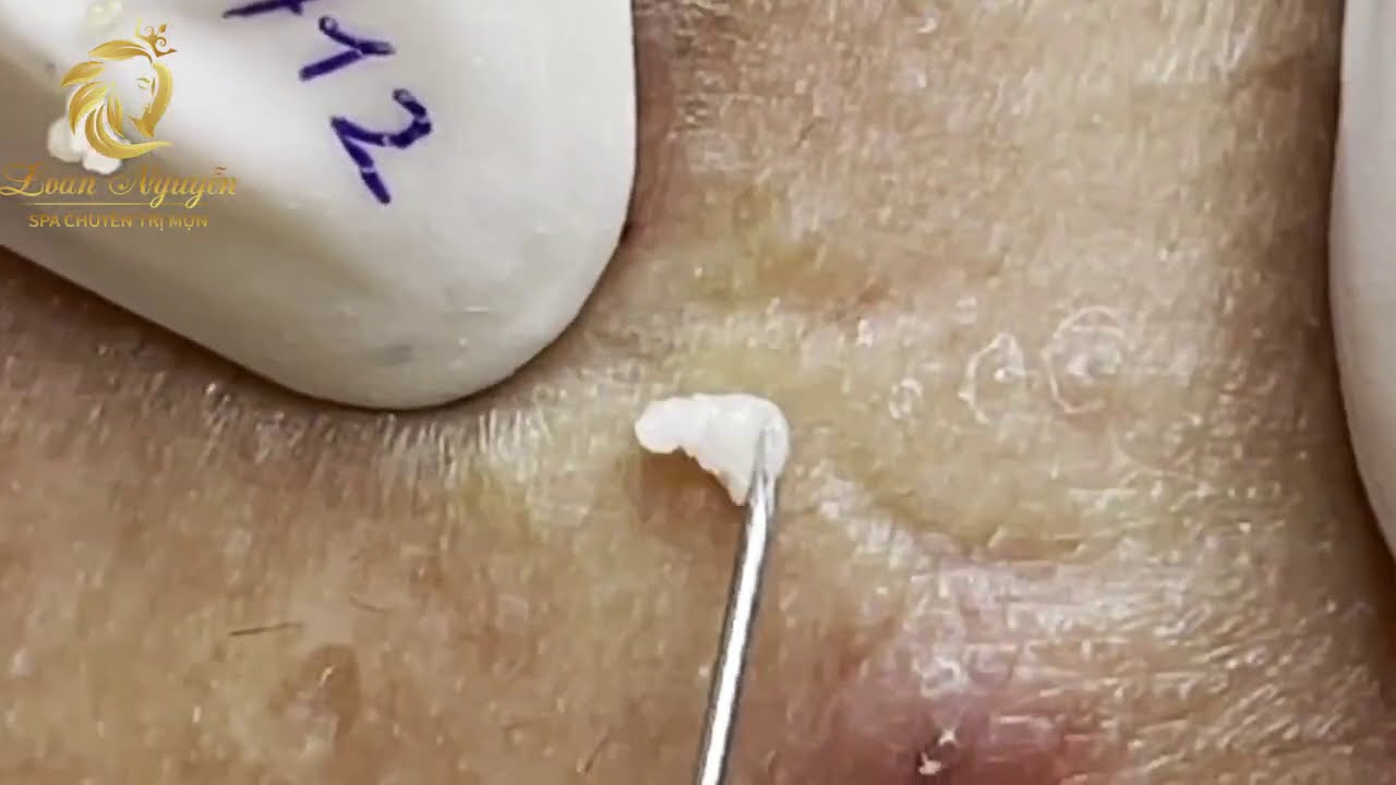 Blackheads extraction (412) | Loan Nguyen