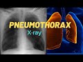 How to identify Pneumothorax in Chest Xray